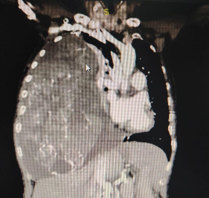 Tumor Pleura - Antes
