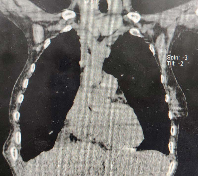 Tumor Pleura - Resultado