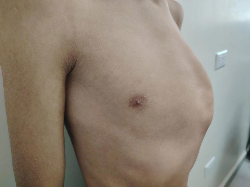 Tratamiento Pectus Carinatum - Antes