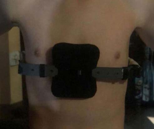 Tratamiento Pectus Carinatum - En uso